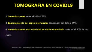 2. Consolidaciones entre el 50% al 62%.
3. Engrosamiento del septo interlobular con rangos del 35% al 59%.
4. Consolidaciones más opacidad en vidrio esmerilado hasta en el 50% de los
casos.
TOMOGRAFIA EN COVID19
Ye Z, Zhang Y, Wang Y, Huang Z, Song B. Chest CT manifestations of new coronavirus disease 2019 (COVID-19): a pictorial review. Eur Radiol. 2020;2019(37):1-
9. doi:10.1007/s00330-020-06801-0
 