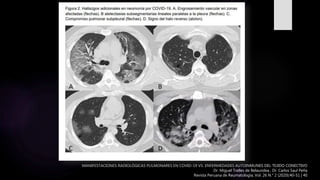 MANIFESTACIONES RADIOLÓGICAS PULMONARES EN COVID-19 VS. ENFERMEDADES AUTOINMUNES DEL TEJIDO CONECTIVO
Dr. Miguel Trelles de Belaundea , Dr. Carlos Saul Peña
Revista Peruana de Reumatología, Vol. 26 N.° 2 (2020):40-51 | 40
 