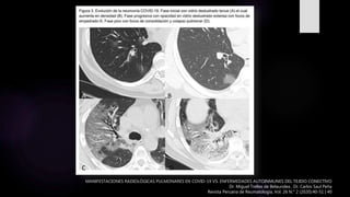 MANIFESTACIONES RADIOLÓGICAS PULMONARES EN COVID-19 VS. ENFERMEDADES AUTOINMUNES DEL TEJIDO CONECTIVO
Dr. Miguel Trelles de Belaundea , Dr. Carlos Saul Peña
Revista Peruana de Reumatología, Vol. 26 N.° 2 (2020):40-51 | 40
 