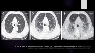 H. Shi, X. Han, N. Jiang y colaboradores Fuente: The Lancet Infectious Diseases Feb 24, 2020 Radiological
findings from 81 patients with COVID-19 pneumonia in Wuhan, China: a descriptive study
 