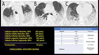 Lóbulo superior derecho: 50% (03 ptos)
Lóbulo medio derecho: 30% (03 ptos)
Lóbulo inferior derecho: 60% (04 ptos)
Lóbulo superior izquierdo: 60% (04 ptos)
Lóbulo inferior izquierdo: 80% (05 ptos)
Puntuación: 19 ptos
CONCLUSIÓN: AFECCIÓN SEVERA
 