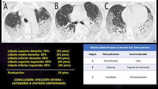 Lóbulo superior derecho: 50% (03 ptos)
Lóbulo medio derecho: 30% (03 ptos)
Lóbulo inferior derecho: 60% (04 ptos)
Lóbulo superior izquierdo: 60% (04 ptos)
Lóbulo inferior izquierdo: 80% (05 ptos)
Puntuación: 19 ptos
CONCLUSIÓN: AFECCIÓN SEVERA –
CATEGORIA B (PATRÓN EMPEDRADO)
 