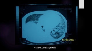 VENTANA PARENQUIMAL
 