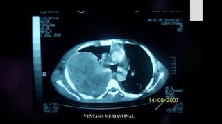 VENTANA MEDIASTINAL
 