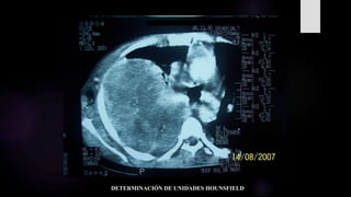 DETERMINACIÓN DE UNIDADES HOUNSFIELD
 