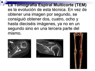 La Tomografía Espiral Multicorte (TEM)  es la evolución de esta técnica. En vez de obtener una imagen por segundo, se consiguió obtener dos, cuatro, ocho y hasta dieciséis imágenes, ya no en un segundo sino en una tercera parte del mismo.  