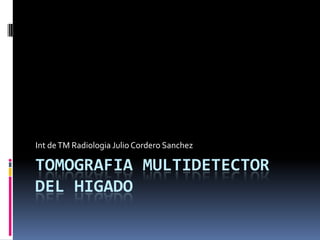 Int de TM Radiologia Julio Cordero Sanchez

TOMOGRAFIA MULTIDETECTOR
DEL HIGADO
 