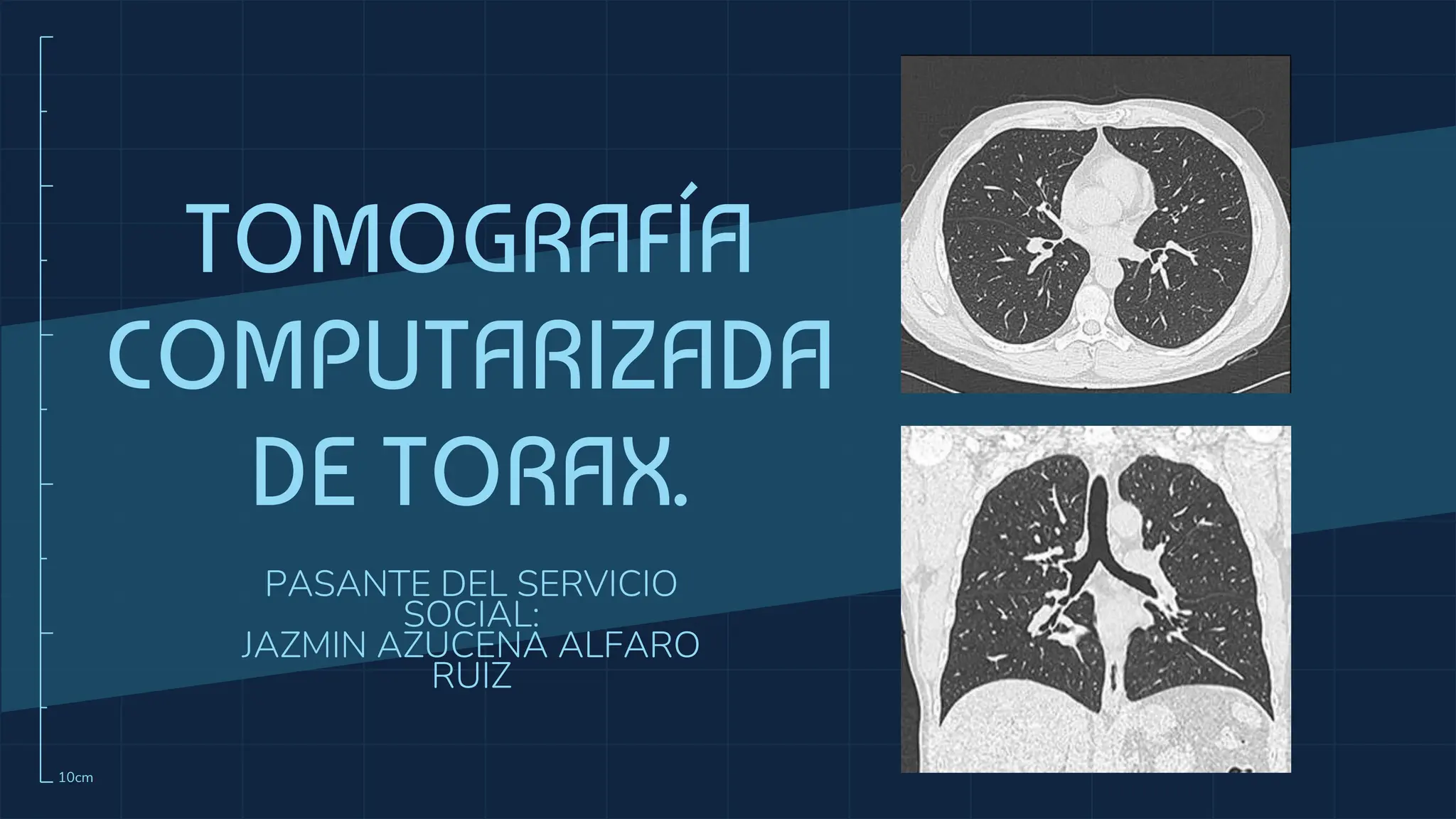 Torax Simple TOMOGRAFIA DE TORAX SIMPLE Y CON CONTRASTE | PPTX