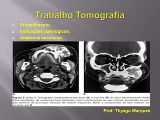 1)   Procedimento.
2)   Indicações patologicas.
3)   Anatomia seccional.




                               Prof: Thyago Marques
 