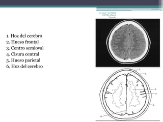 1. Hoz del cerebro 
2. Hueso frontal 
3. Centro semioval 
4. Cisura central 
5. Hueso parietal 
6. Hoz del cerebro 
10010337- ALVAREZ 
CASTRO, Miguel 
Eduardo 
 