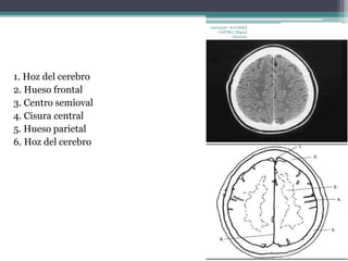 1. Hoz del cerebro 
2. Hueso frontal 
3. Centro semioval 
4. Cisura central 
5. Hueso parietal 
6. Hoz del cerebro 
10010337- ALVAREZ 
CASTRO, Miguel 
Eduardo 
 