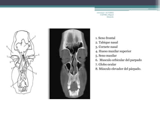 10010337- ALVAREZ 
CASTRO, Miguel 
Eduardo 
1. Seno frontal 
2. Tabique nasal 
3. Cornete nasal 
4. Hueso maxilar superior 
5. Seno maxilar 
6. Musculo orbicular del parpado 
7. Globo ocular 
8. Músculo elevador del párpado. 
 
