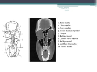 10010337- ALVAREZ 
CASTRO, Miguel 
Eduardo 
1. Seno frontal 
2. Globo ocular 
3. Seno maxilar 
4. Hueso maxilar superior 
5. Lengua 
6. Tabique nasal 
7. Cornete nasal inferior 
8. Tabique nasal 
9. Celdillas etmoidales 
10. Hueso frontal 
 