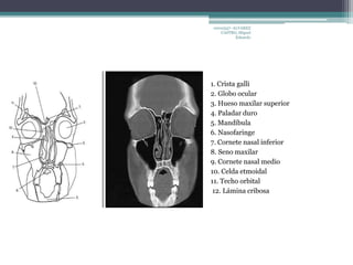 10010337- ALVAREZ 
CASTRO, Miguel 
Eduardo 
1. Crista galli 
2. Globo ocular 
3. Hueso maxilar superior 
4. Paladar duro 
5. Mandíbula 
6. Nasofaringe 
7. Cornete nasal inferior 
8. Seno maxilar 
9. Cornete nasal medio 
10. Celda etmoidal 
11. Techo orbital 
12. Lámina cribosa 
 