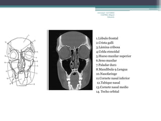 10010337- ALVAREZ 
CASTRO, Miguel 
Eduardo 
1.Lóbulo frontal 
2.Crista galli 
3.Lámina cribosa 
4.Celda etmoidal 
5.Hueso maxilar superior 
6.Seno maxilar 
7.Paladar duro 
8.Mandíbula 9.Lengua 
10.Nasofaringe 
11.Cornete nasal inferior 
12.Tabique nasal 
13.Cornete nasal medio 
14. Techo orbital 
 