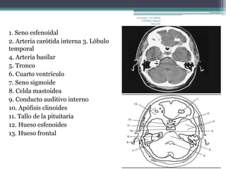 1. Seno esfenoidal 
2. Arteria carótida interna 3. Lóbulo 
temporal 
4. Arteria basilar 
5. Tronco 
6. Cuarto ventrículo 
7. Seno sigmoide 
8. Celda mastoidea 
9. Conducto auditivo interno 
10. Apófisis clinoides 
11. Tallo de la pituitaria 
12. Hueso esfenoides 
13. Hueso frontal 
10010337- ALVAREZ 
CASTRO, Miguel 
Eduardo 
 