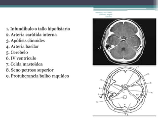 1. Infundíbulo o tallo hipofisiario 
2. Arteria carótida interna 
3. Apófisis clinoides 
4. Arteria basilar 
5. Cerebelo 
6. IV ventrículo 
7. Celda mastoidea 
8. Seno petroso superior 
9. Protuberancia bulbo raquídeo 
10010337- ALVAREZ 
CASTRO, Miguel 
Eduardo 
 