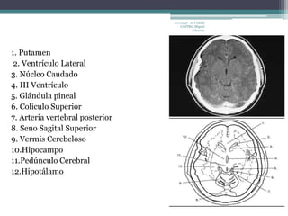 1. Putamen 
2. Ventrículo Lateral 
3. Núcleo Caudado 
4. III Ventrículo 
5. Glándula pineal 
6. Coliculo Superior 
7. Arteria vertebral posterior 
8. Seno Sagital Superior 
9. Vermis Cerebeloso 
10.Hipocampo 
11.Pedúnculo Cerebral 
12.Hipotálamo 
10010337- ALVAREZ 
CASTRO, Miguel 
Eduardo 
 