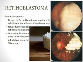 RETINOBLASTOMA
Acompanhamento
• Depois da Rx ou Qx, o tumor regride e forma uma massa
calcificada, semelhante a “queijo cottage”.
• Novos tumores podem se desenvolver em pacientes com
retinoblastoma hereditário;
• Se o retinoblastoma tiver sido tratado de modo conservador,
deve ser realizado exame com anestesia a cada 2 a 8 semanas.
• A RM da órbita é indicada em casos de alto risco por cerca de
18 meses.
 