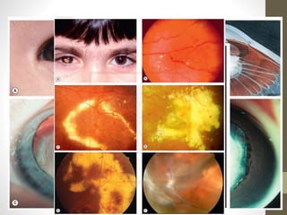 RETINOBLASTOMA
Diagnóstico diferencial
1. A vascularização fetal anterior persistente
2. A vascularização fetal posterior persistente
3. A doença de Coats
4. Retinopatia da prematuridade
 
