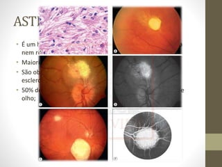ASTROCITOMA
• É um hamartoma raro que geralmente não ameaça a visão
nem requer tratamento;
• Maioria é endofítica;
• São observados com maior frequência nos pacientes com
esclerose tuberosa e retinite ;
• 50% destes paciente apresentam astrocitomas no fundo de
olho;
 