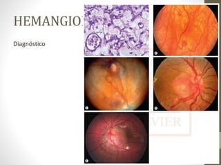 HEMANGIOMA CAPILAR
Diagnóstico
 