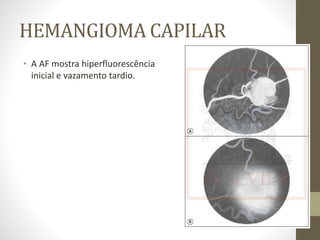 HEMANGIOMA CAPILAR
• A AF mostra hiperfluorescência
inicial e vazamento tardio.
 