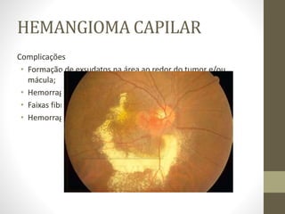 HEMANGIOMA CAPILAR
Complicações
• Formação de exsudatos na área ao redor do tumor e/ou
mácula;
• Hemorragia e vazamento devido ao edema de mácula e DR.
• Faixas fibróticas;
• Hemorragia do vítreo, glaucoma secundário e phthsis bulbi.
 