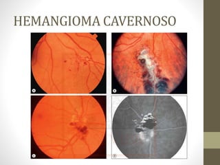 HEMANGIOMA CAVERNOSO
 
