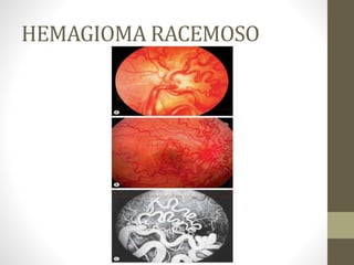 HEMAGIOMA RACEMOSO
 