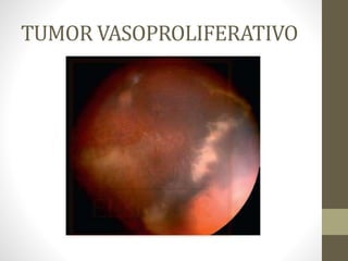 TUMOR VASOPROLIFERATIVO
 