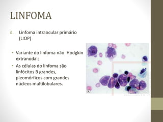 LINFOMA
d. Linfoma intraocular primário
(LIOP)
• Variante do linfoma não Hodgkin
extranodal;
• As células do linfoma são
linfócitos B grandes,
pleomórficos com grandes
núcleos multilobulares.
 