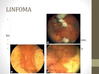 LINFOMA
• Apresentação ocorre entre a sexta e a sétima década com
moscas volantes, visão embaçada, olho vermelho ou
fotofobia;
Sinais
• Uveíte anterior leve com células, flare e precipitados ceráticos.
• Grandes infiltrados sub-retinianos multifocais sólidos
• Vasculite retiniana, oclusão vascular DR exsudativo e atrofia
óptica.
 