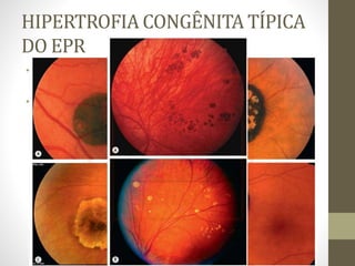 HIPERTROFIA CONGÊNITA TÍPICA
DO EPR
• É uma lesão benigna comum
• Pode ser típica (isolada ou agrupada) ou atípica.
 