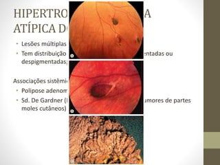 HIPERTROFIA CONGÊNITA
ATÍPICA DO EPR
• Lesões múltiplas bilaterais, muito separadas;
• Tem distribuição aleatória e podem ser pigmentadas ou
despigmentadas;
Associações sistêmicas
• Polipose adenomatosa familiar (PAF)
• Sd. De Gardner (PAF + osteomas de crânio +tumores de partes
moles cutâneos)
 