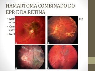 HAMARTOMA COMBINADO DO
EPR E DA RETINA
• Malformação rara, unilateral, congênita e predominantemente
no sexo masculino.
• Ocorre no final da infância ou início da fase adulta, com
estrabismo, visão turva e metamorfopsia.
• Nenhum tratamento é inidicado.
 