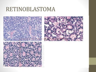 RETINOBLASTOMA
Patologia:
1. Histologia:
• Tumor composto de pequenas células basofílicas com grandes
núcleos hipercromáticos e citoplasma escasso.
• Muitos retinoblastomas são indiferenciados;
 