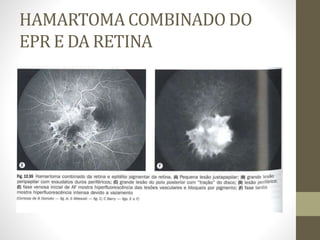 HAMARTOMA COMBINADO DO
EPR E DA RETINA
 