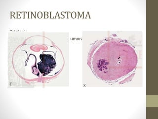 RETINOBLASTOMA
Patologia
2. Padrões de disseminação tumoral
a. O padrão de crescimento
b. Invasão do nervo óptico
c. Infiltração difusa
d. Disseminação metastática
 