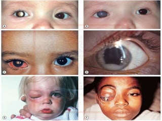 RETINOBLASTOMA
Apresentação
• Leucocoria
• Estrabismo
• Glaucoma secundário
• Retinoblastoma difuso que invade segmento anterior;
• Inflamação da órbita
• Invasão da órbita com proptose e invasão óssea;
 