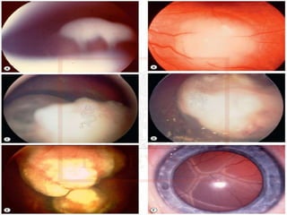 RETINOBLASTOMA
Sinais
• Um tumor intrarretiniano é uma lesão brancacenta,
homogênea e abaulada.
• Um tumor endofítico projeta-se para o vítreo como uma
“massa semeada”.
• Um tumor exofítico forma massas brancas multilobulares sub-
retinianas.
 