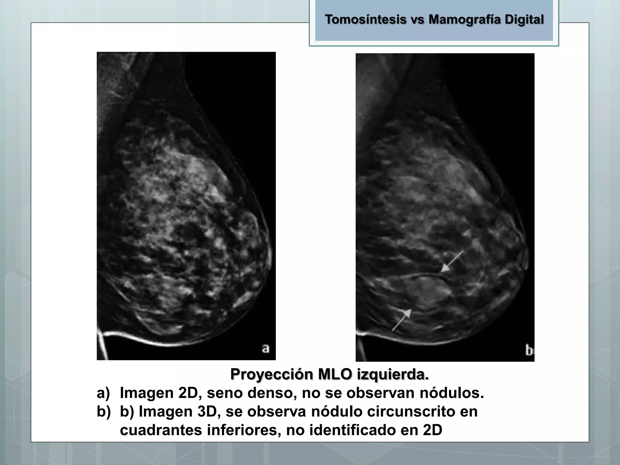 Proyección MLO izquierda.
a) Imagen 2D, seno denso, no se observan nódulos.
b) b) Imagen 3D, se observa nódulo circunscrito en
cuadrantes inferiores, no identificado en 2D
Tomosíntesis vs Mamografía Digital
 