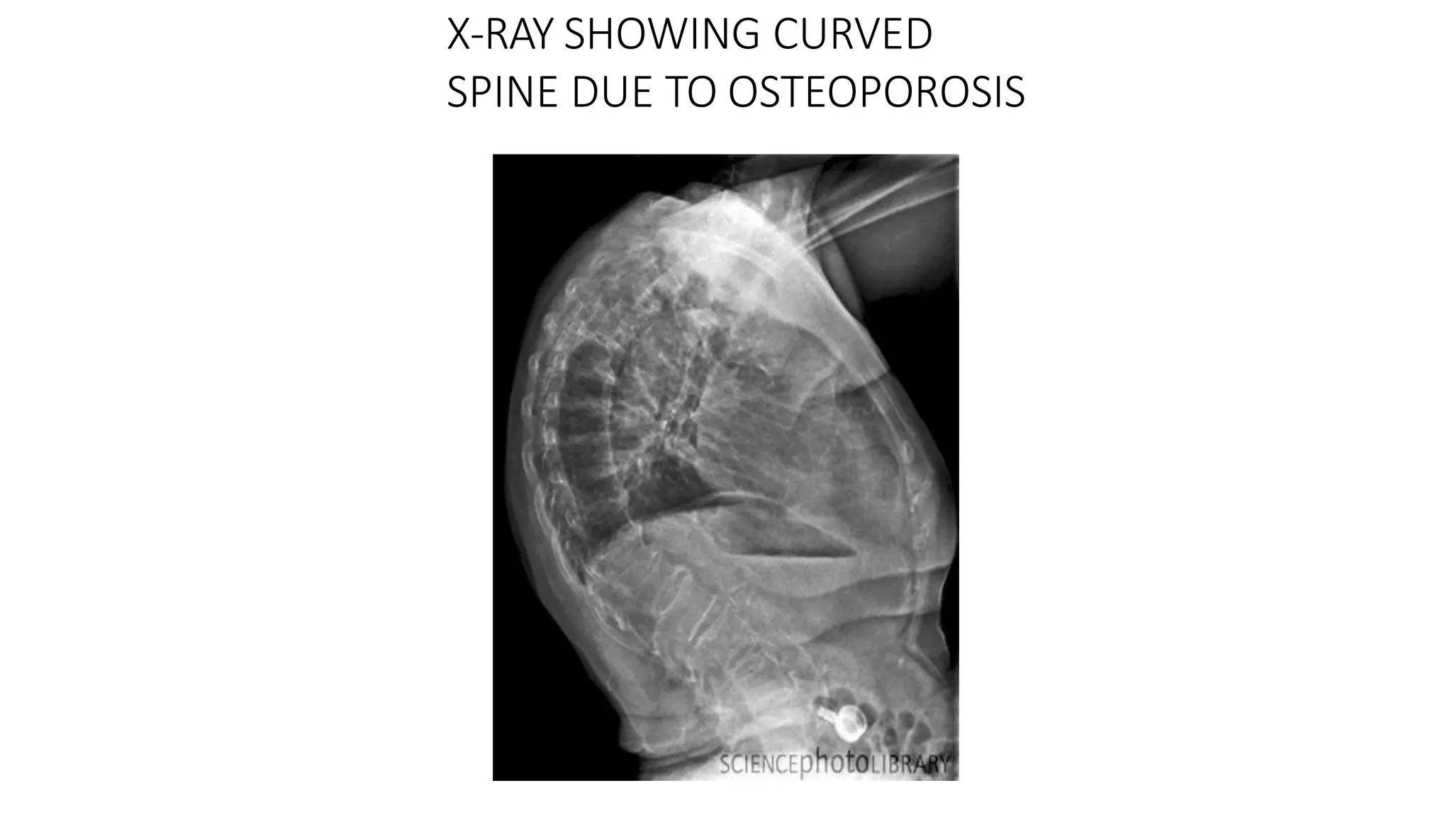 X-RAY SHOWING CURVED
SPINE DUE TO OSTEOPOROSIS
 