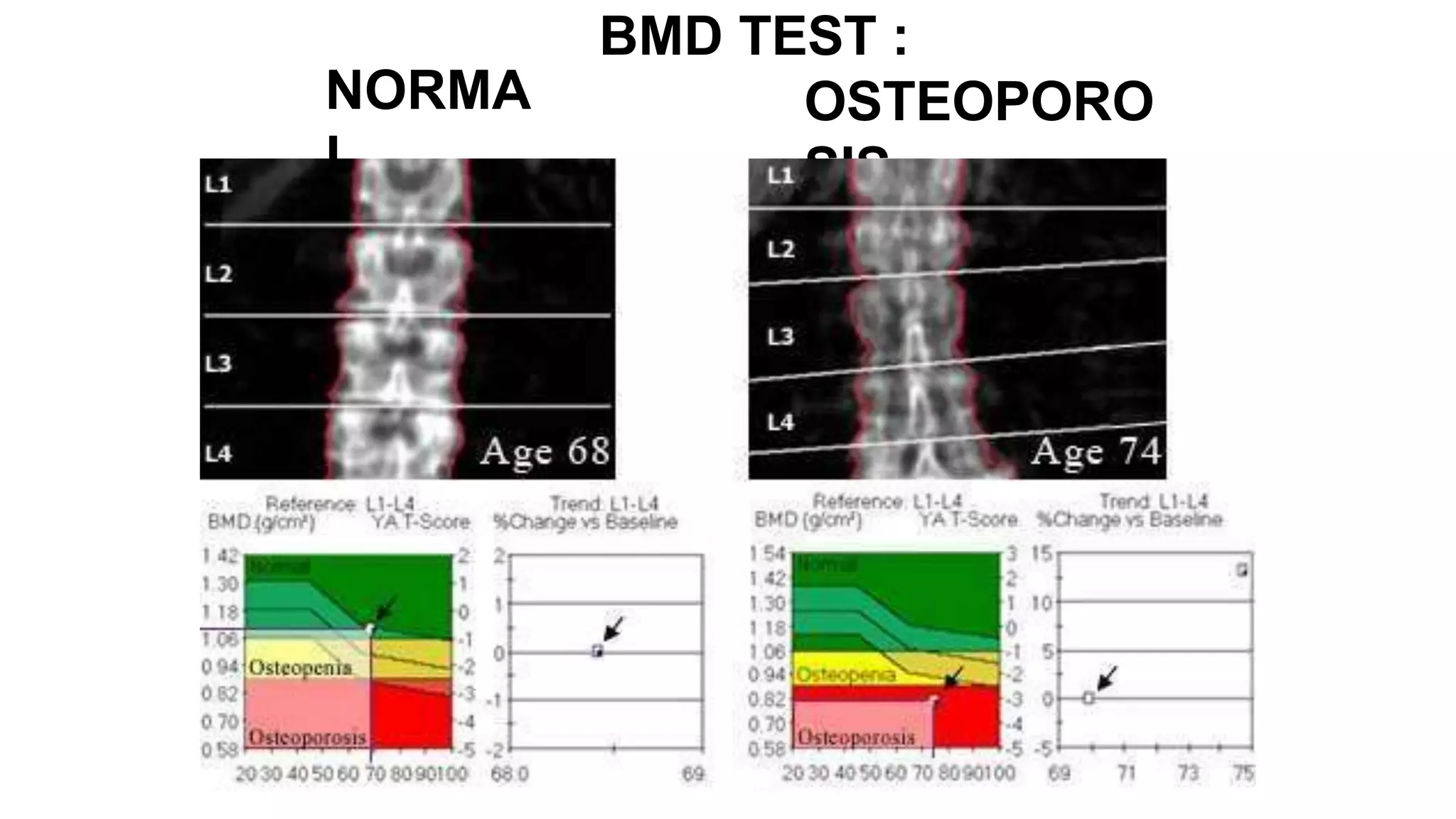 NORMA
L
BMD TEST :
OSTEOPORO
SIS
 