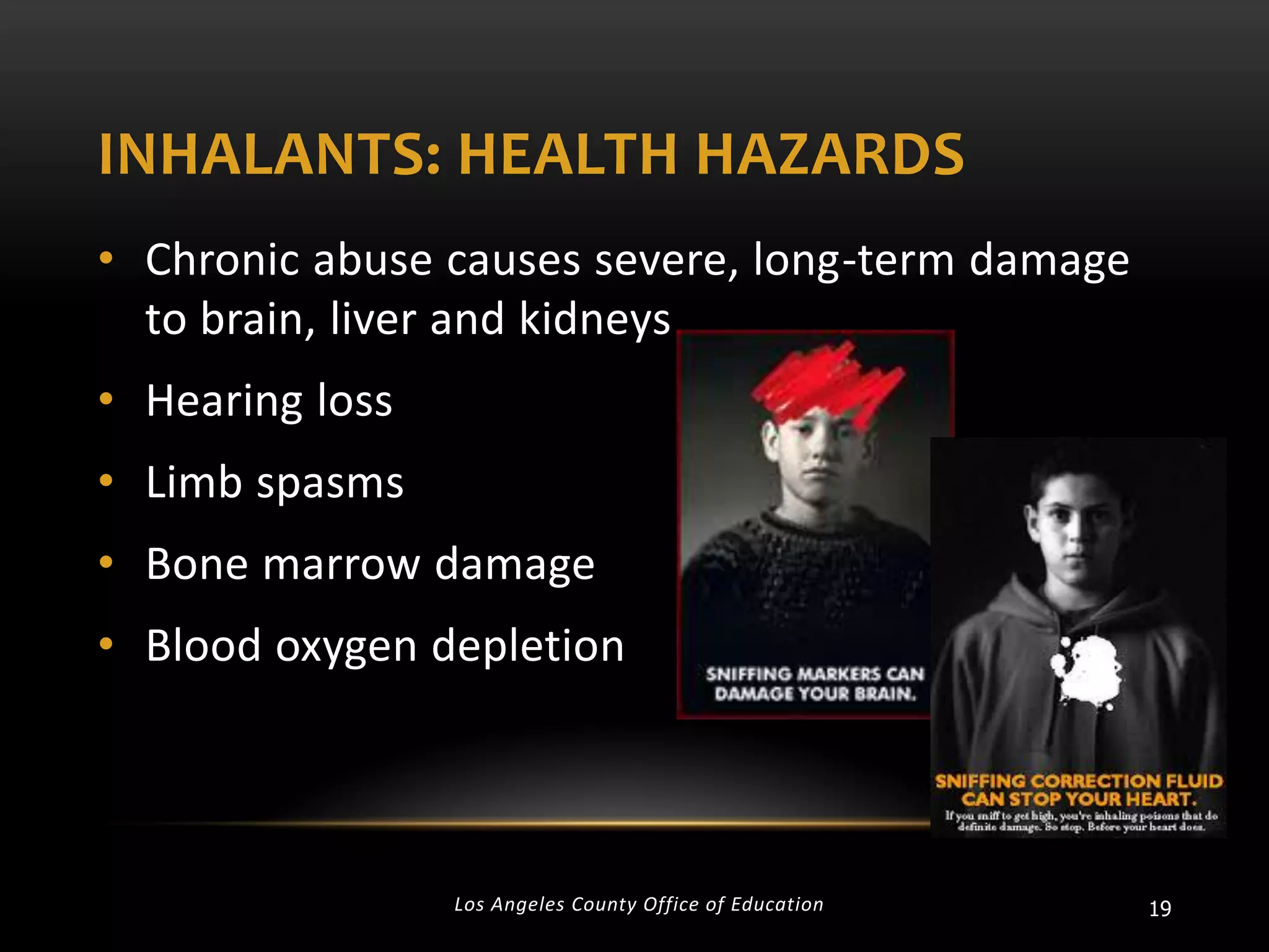 INHALANTS: HEALTH HAZARDS
• Chronic abuse causes severe, long-term damage
to brain, liver and kidneys
• Hearing loss
• Limb spasms
• Bone marrow damage
• Blood oxygen depletion

Los Angeles County Office of Education

19

 