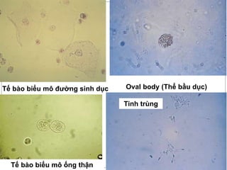 Tế bào biểu mô đường sinh dục
Tế bào biểu mô ống thận
Oval body (Thể bầu dục)
Tinh trùng
 