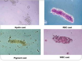 Hyalin cast RBC cast
Pigment cast WBC cast
 