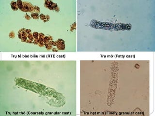 Trụ tế bào biểu mô (RTE cast) Trụ mỡ (Fatty cast)
Trụ hạt thô (Coarsely granular cast) Trụ hạt mịn (Finely granular cast)
 