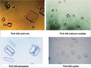 Tinh thể acid uric
Tinh thể phosphat
Tinh thể calcium oxalate
Tinh thể cystin
 