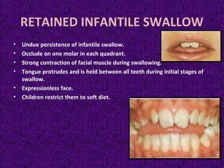 RETAINED INFANTILE SWALLOW
• Undue persistence of infantile swallow.
• Occlude on one molar in each quadrant.
• Strong contraction of facial muscle during swallowing.
• Tongue protrudes and is held between all teeth during initial stages of
swallow.
• Expressionless face.
• Children restrict them to soft diet.
 